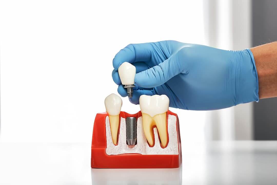 Dental Implants, Computerized Implantation