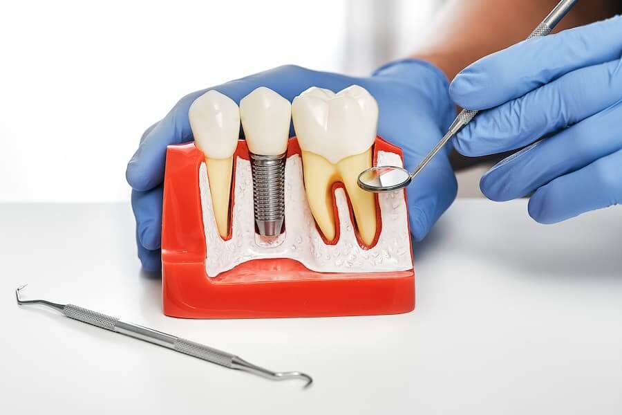 Повторная зубная имплантация или Что делать в случае отторжения имплантата?