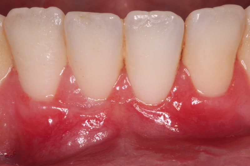 Mucogingival Surgery After