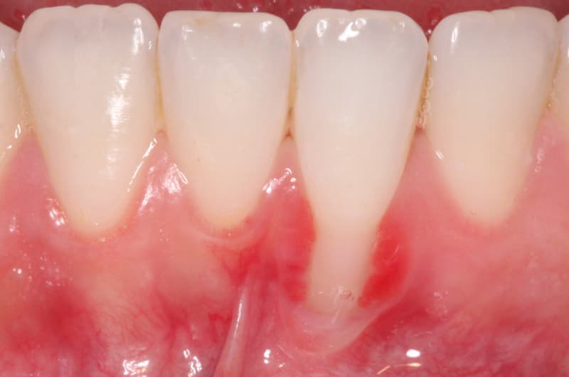 Mucogingival Surgery Before