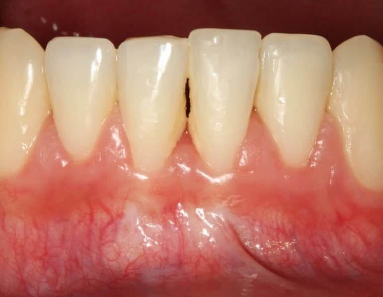 Mucogingival Surgery After