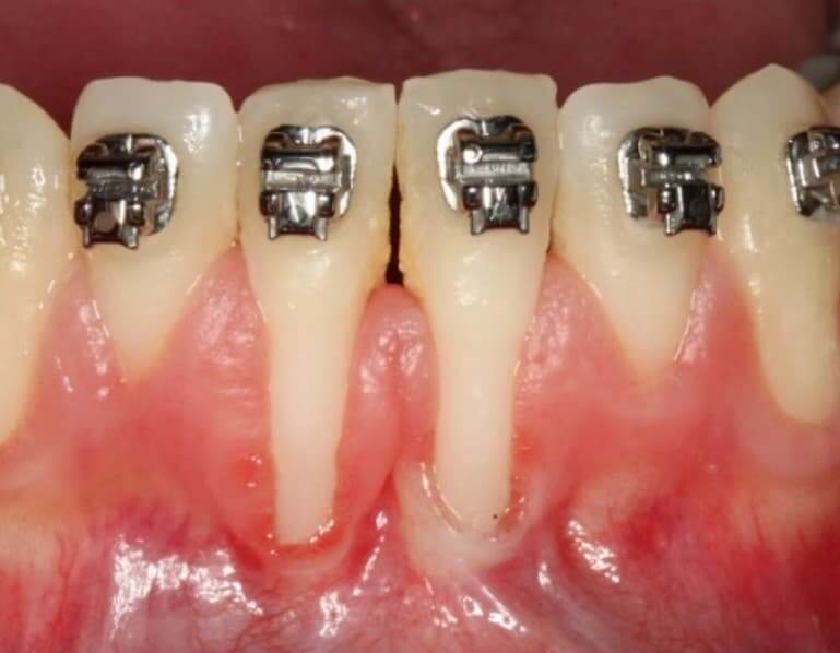 Mucogingival Surgery Before