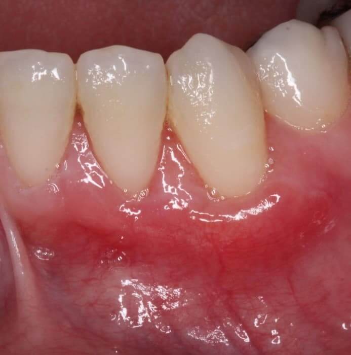 Mucogingival Surgery After