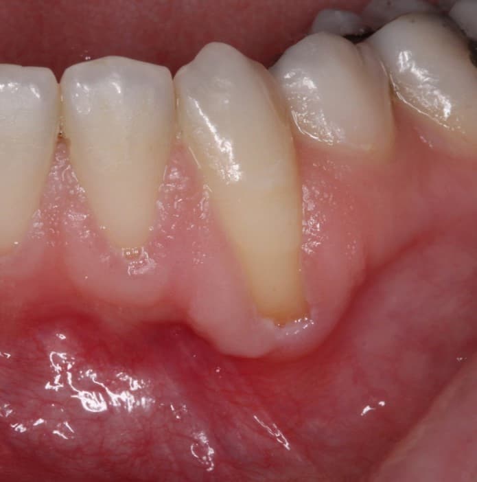 Mucogingival Surgery Before