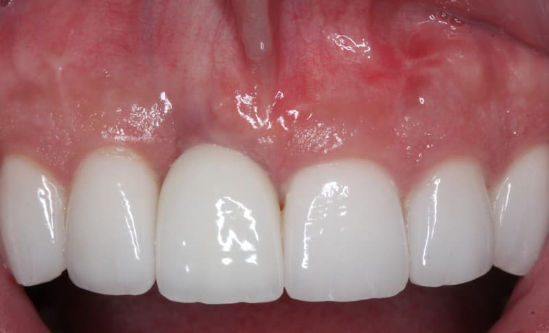 Mucogingival Surgery After