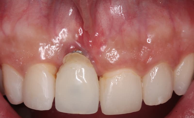 Mucogingival Surgery Before