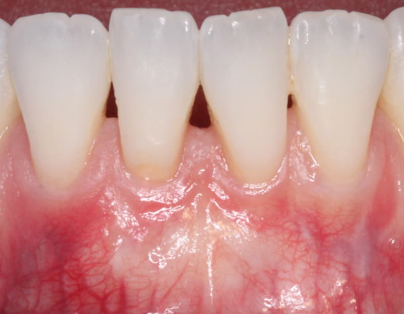 Mucogingival Surgery After