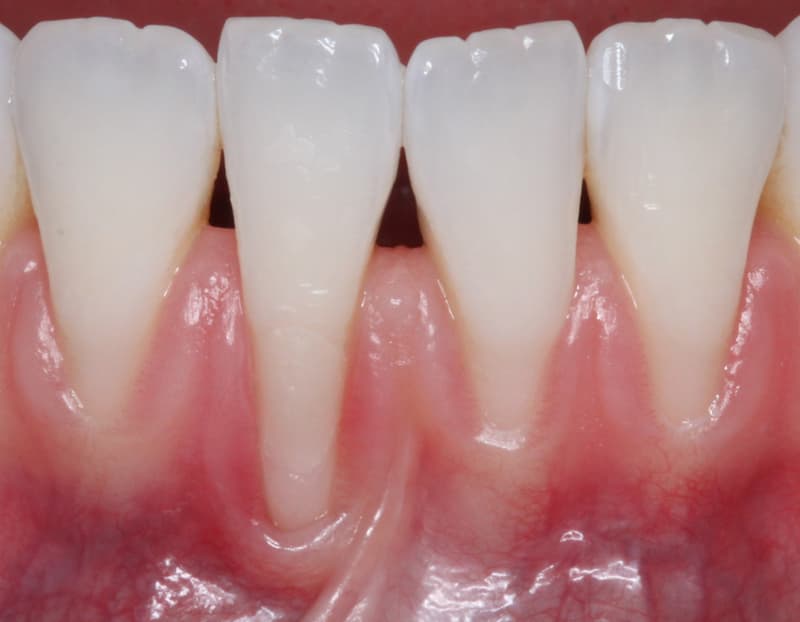 Mucogingival Surgery Before