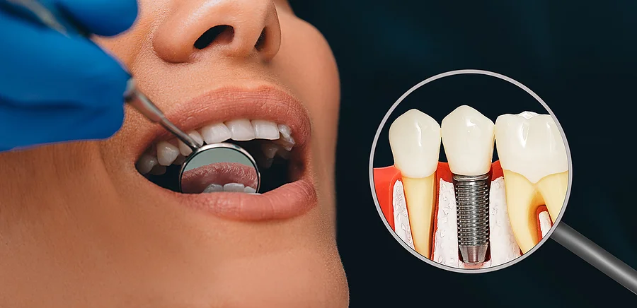 לשאול מה האפשרויות לביצוע השתלת השיניים