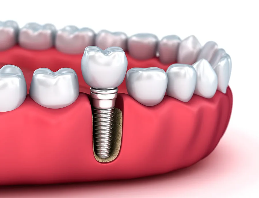 הקשר בין השתלת שיניים לאוכל קשור גם לגוף ולנפש