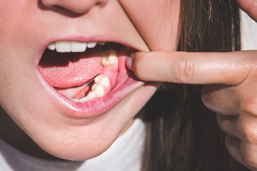 הצורך בעצם הלסת בהליך השתלת שיניים